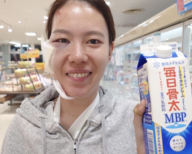 骨折した時は顔がパンパンでした